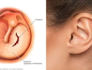 Kulak Zarı Delinmesi Nasıl Olur? Nasıl Geçer?