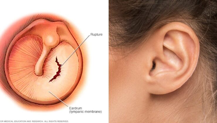 Kulak Zarı Delinmesi Nasıl Olur? Nasıl Geçer?