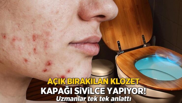 Açık Bırakılan Klozet Kapağı Sivilce Yapıyor! Uzmanlar Tek Tek Anlattı