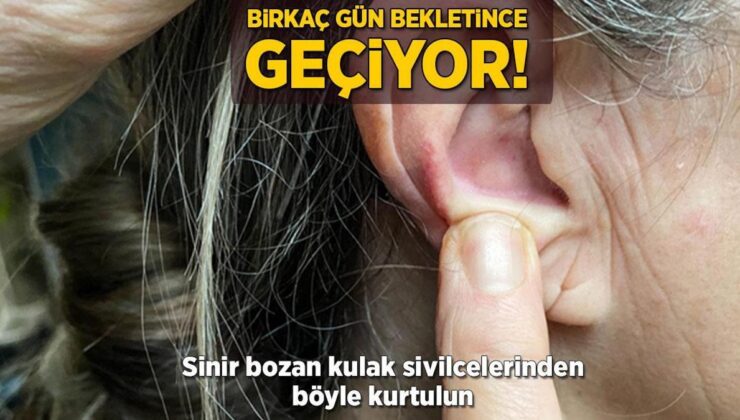 Birkaç Gün Bekletince Geçiyor! Sinir Bozan Kulak Sivilcelerinden Böyle Kurtulun