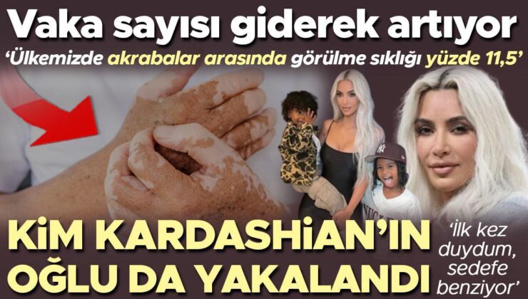 Hadise Sayısı Giderek Artıyor! Kardashian’ın Oğlu da Yakalandı… ‘İlk Kez Duydum, Sedefe Benziyor’ | ‘Ülkemizde Görülme Sıklığı Yüzde 11,5’