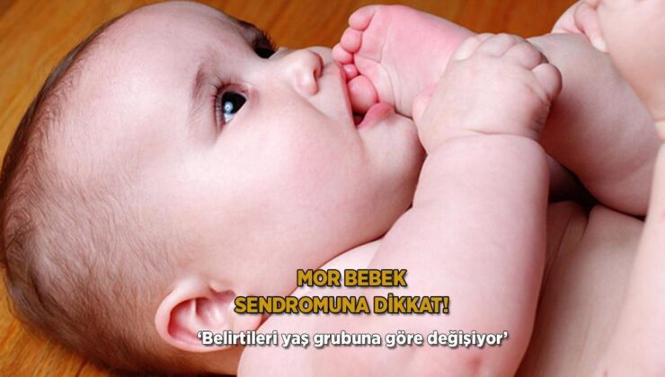 Mor Bebek Sendromuna Dikkat! ‘Belirtileri Yaş Grubuna Göre Değişiyor’