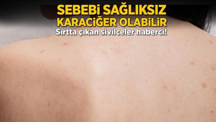 Sebebi Sıhhatsiz Karaciğer Olabilir! Sırtta Çıkan Sivilceler Haberci