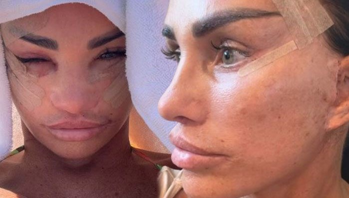 Defalarca Yüzünü Gerdiren Katie Price’ın Son Haline Yorum Yağdı! ‘Estetik Yaptırmadan Duramıyorum’ Demişti