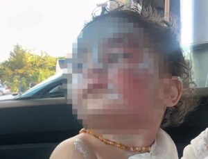 Aden Bebeğe Kreşte Ne Oldu? Okul “Kahve Döküldü” Dedi, Aile Reddediyor: “Yanıklar Çok Daha Derin”