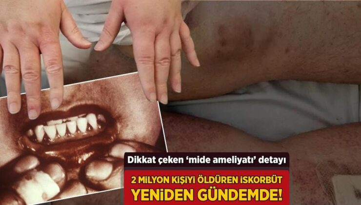 2 Milyon Kişiyi Öldüren İskorbüt Yeniden Gündemde! Dikkat Çeken ‘Mide Ameliyatı’ Ayrıntısı