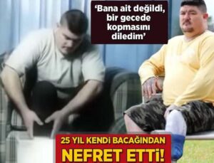 25 Yıl Kendi Bacağından Nefret Etti! ‘Bana Ait Değildi, Bir Gecede Kopmasını Diledim’