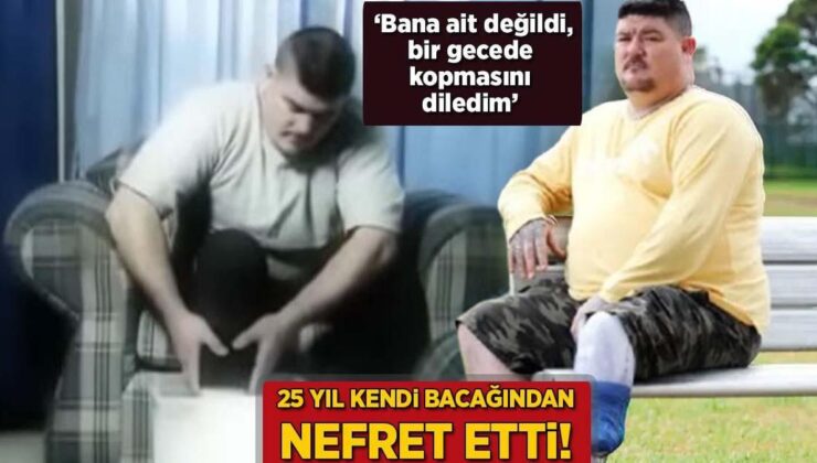 25 Yıl Kendi Bacağından Nefret Etti! ‘Bana Ait Değildi, Bir Gecede Kopmasını Diledim’