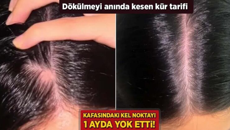 Başındaki Kel Noktayı 1 Ayda Yok Etti! Dökülmeyi Anında Kesen Kür Tanımı