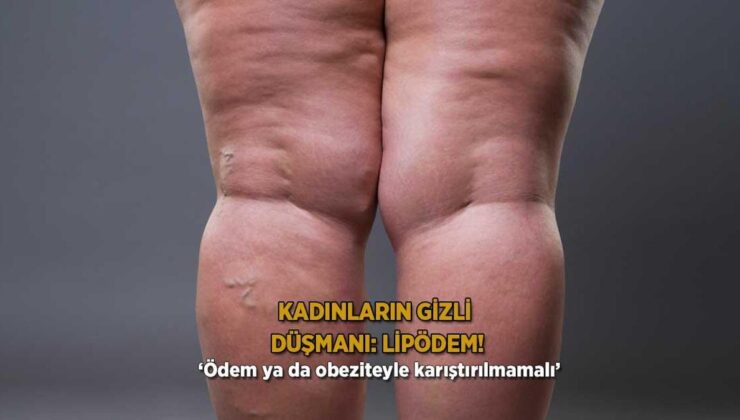 Kadınların Gizli Düşmanı: Lipödem! ‘Ödem Ya da Obeziteyle Karıştırılmamalı’