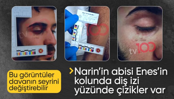 Narin Davasının Seyri Değişecek: Enes Güran’ın Kolunda Diş, Yüzünde Çizikler Var