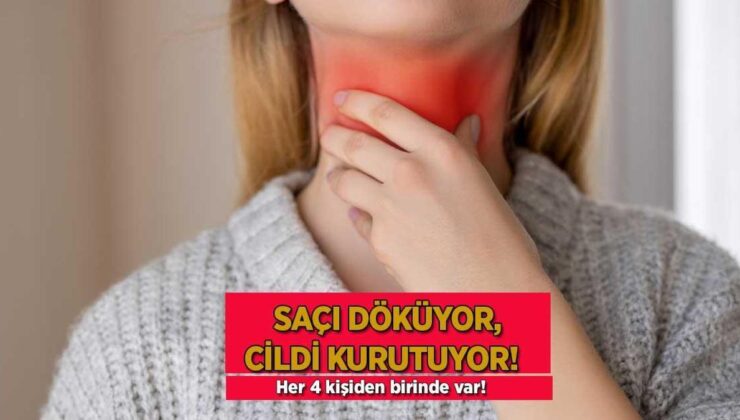 Her 4 Kişiden Birinde Var! ‘Saçı Döküyor, Cildi Kurutuyor, Halsizliğe Neden Oluyor’