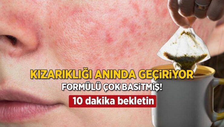 Kızarıklığı Anında Geçiren Formül! Ne Sivilce Ne Soğuk Tanıyor, 10 Dakika Demleyin