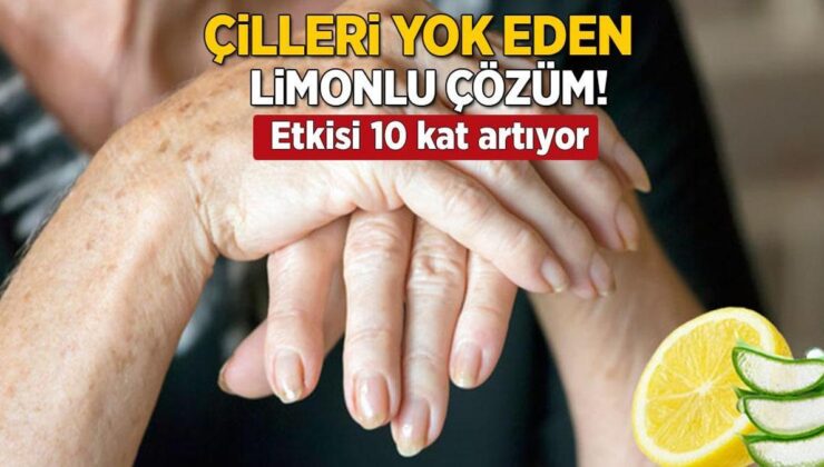 Çilleri Yok Eden Limonlu Çözüm! Bu Bitkiyle Birleşince Etkisi 10 Kat Artıyor